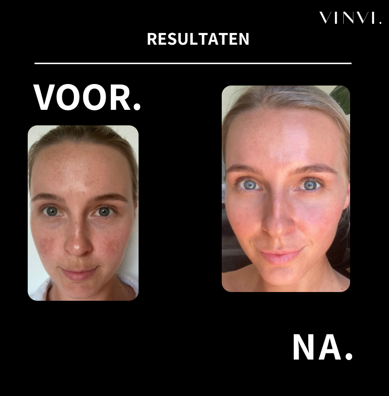 Professionele huidverzorging zonder salonprijzen