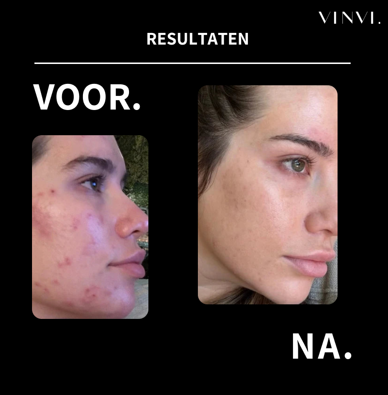 Professionele huidverzorging zonder salonprijzen